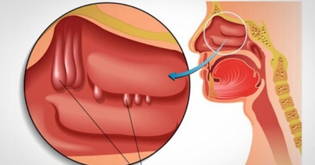 Nghẹt mũi, khó thở là biểu hiện của bệnh gì?