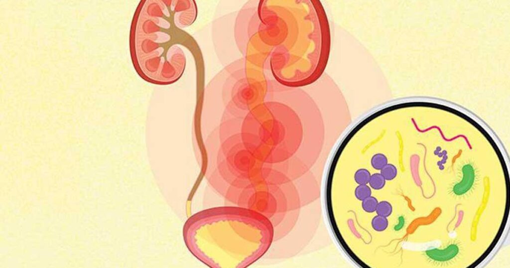 Nhiễm khuẩn tiết niệu có biểu hiện như thế nào?