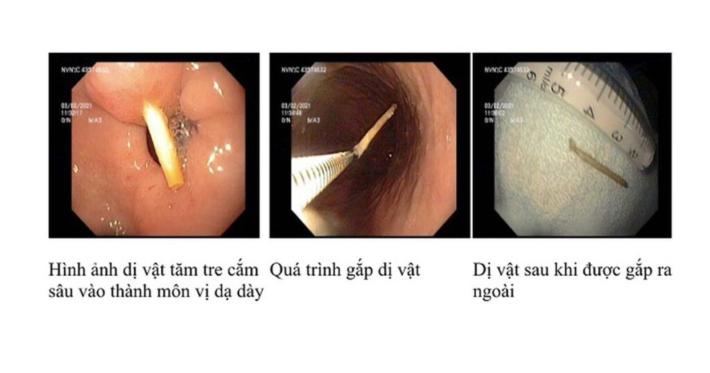 Thói quen ngậm tăm sau ăn hệ lụy khó lường