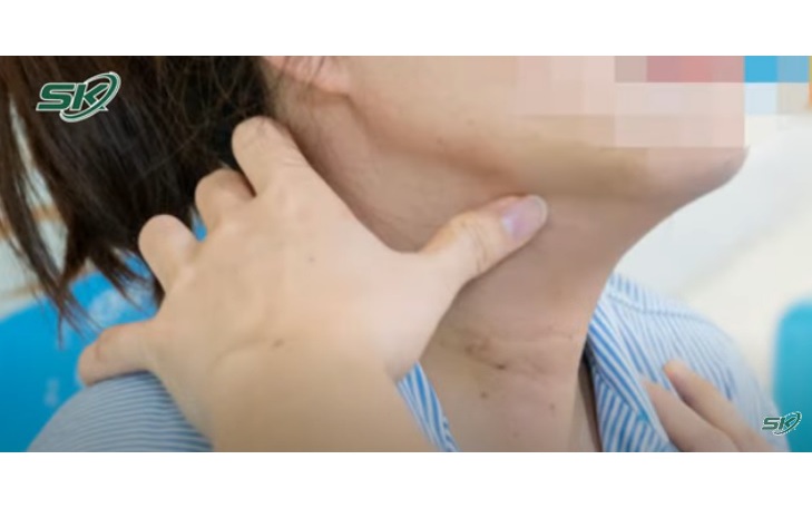 Viêm tuyến giáp mạn tính có làm tăng nguy cơ ung thư tuyến giáp không ?