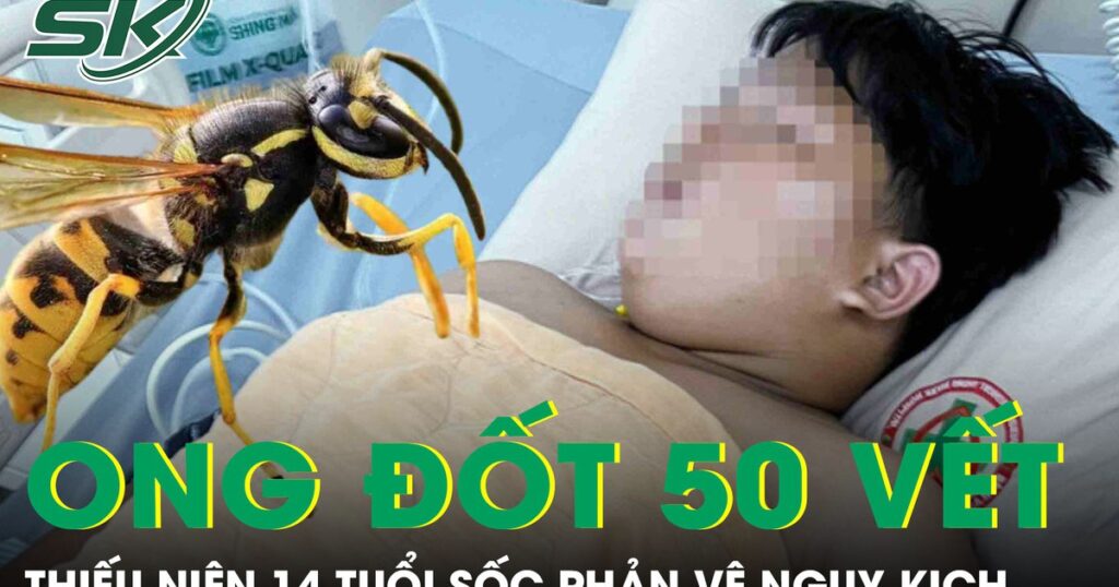 Bị ong vò vẽ đốt hơn 50 vết, thiếu niên 14 tuổi hoại tử, sốc phản vệ nguy kịch
