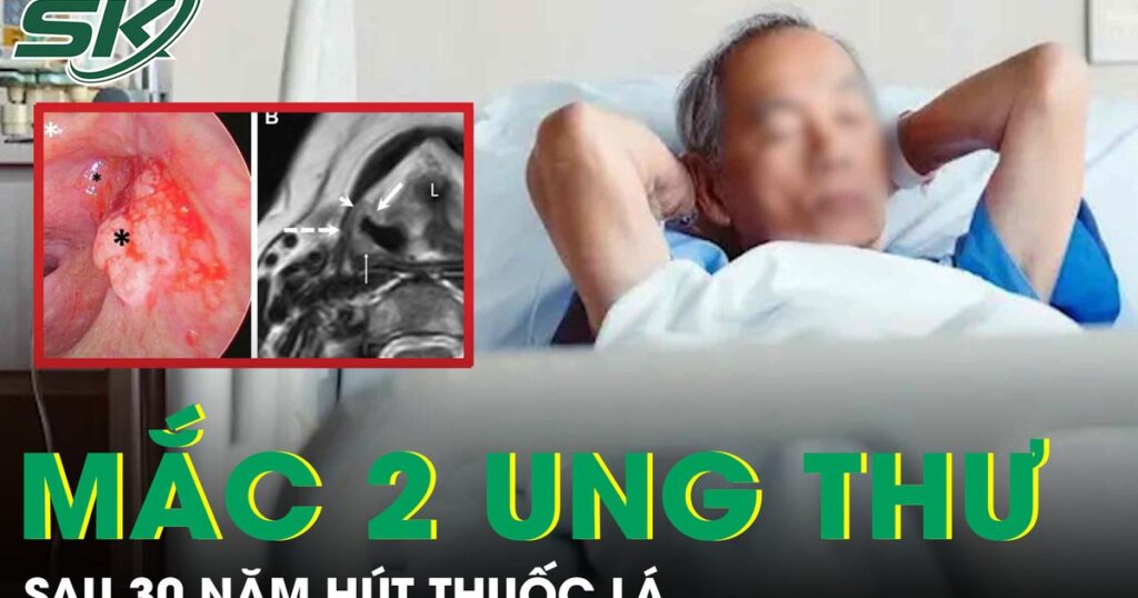 Người đàn ông 56 tuổi mắc cùng lúc hai ung thư sau 30 năm hút thuốc lá