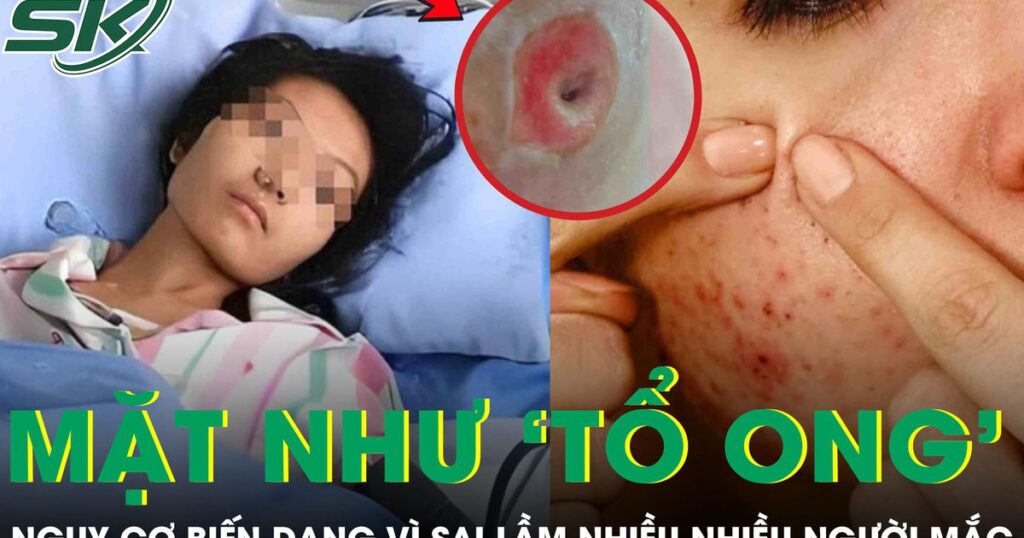 Người phụ nữ chết lặng khi thấy mặt như ‘tổ ong’, nguy cơ biến dạng vì sai lầm nhiều người mắc