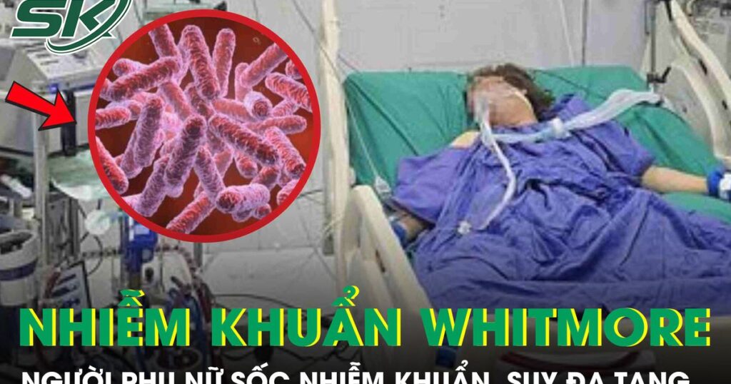 Người phụ nữ 43 tuổi sốc nhiễm khuẩn, suy đa tạng sau 5 ngày sốt