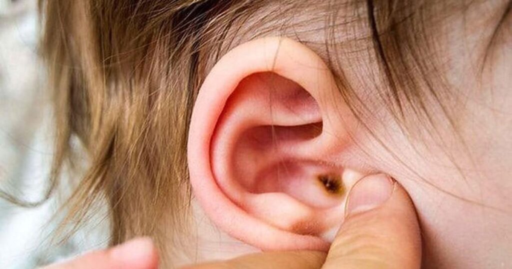 Dấu hiệu nhọt ống tai ngoài ở trẻ và cách xử trí đúng