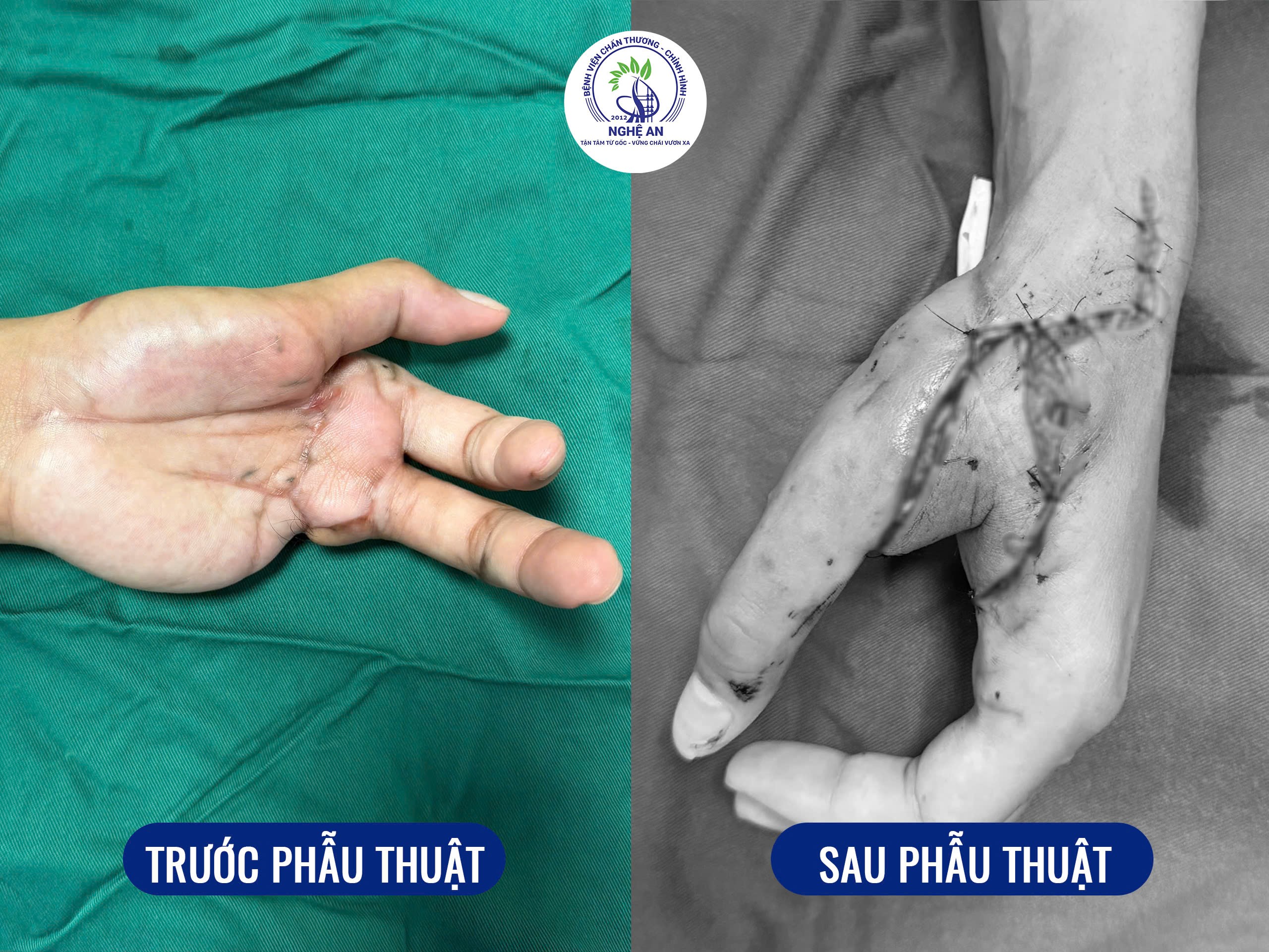 Bước tiến trong phẫu thuật vi phẫu: Chuyển vạt SCIP tự do được triển khai tại Nghệ An- Ảnh 2.