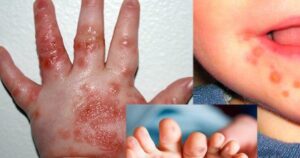 Lâm Đồng ghi nhận 2.265 ca mắc tay chân miệng, một ca tử vong do chủng EV71
